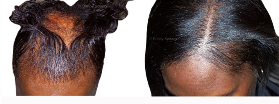 AFRICAN-AMERICAN HAIR LOSS SOLUTIONS - Bobby Spence