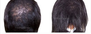 how to grow natural black hair back in the crown and edges fast