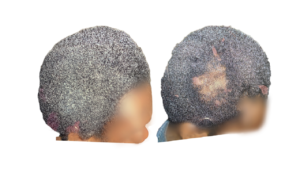 black hair loss alopecia areata before and after