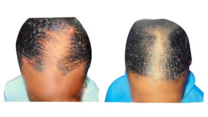 black hair loss front of head before and after